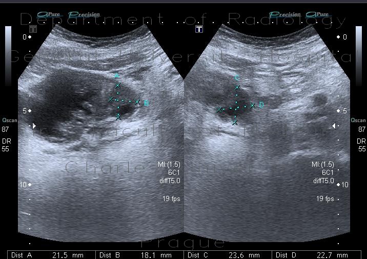 Cystitis, acute cystitis