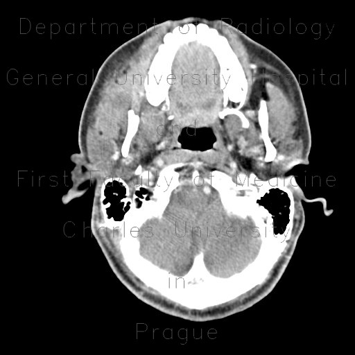 Deposits of oil in the masseter and tonsil