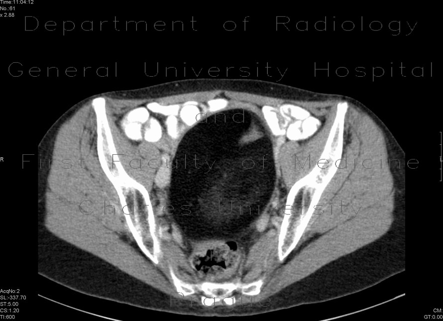 Dermoid of the ovary
