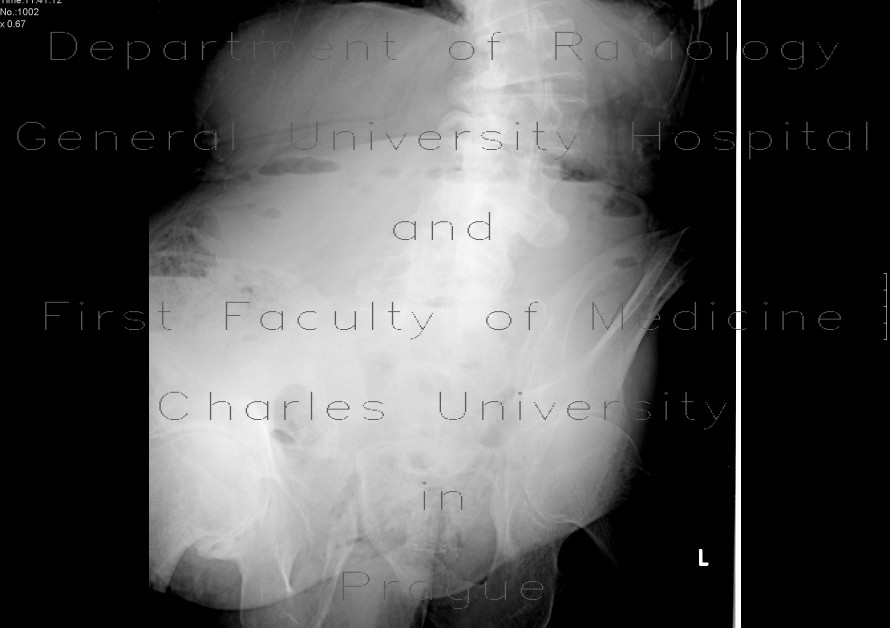 Development of ileus