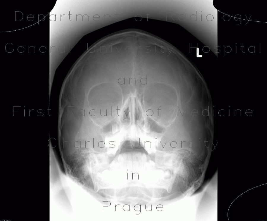 Development of paranasal sinuses, six years, Waters view