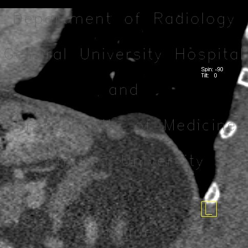 Diaphragmatic hernia, diaphragm