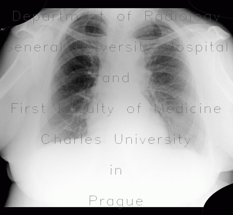 Diaphragmatic lobulation