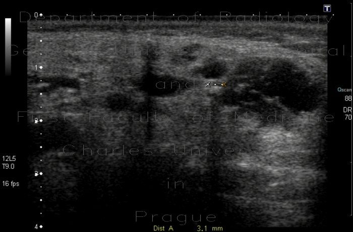 Dilated Wharton's duct, sialolithiasis
