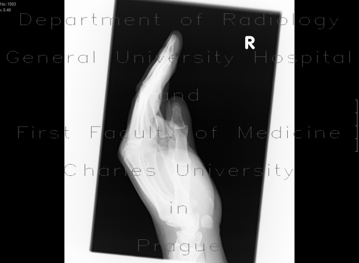 Dislocation of interphalangeal joint of thumb