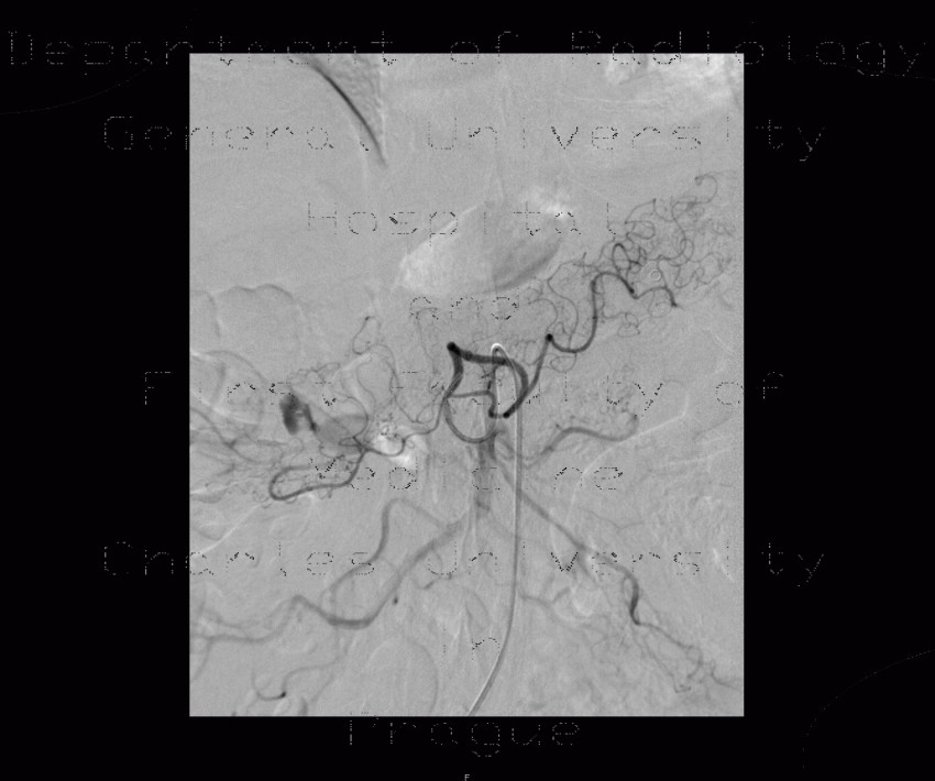 Diverticular bleeding, embolisation