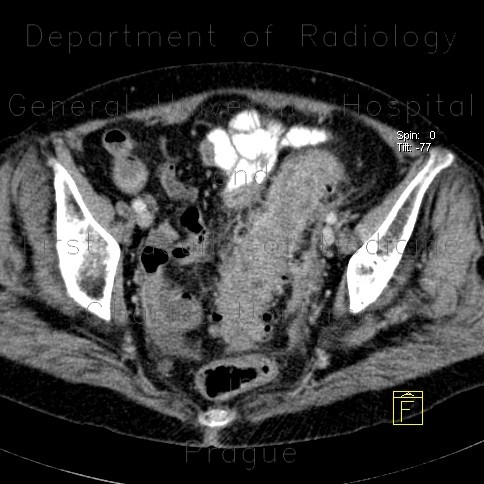 Diverticulitis, acute diverticulitis, peritonitis