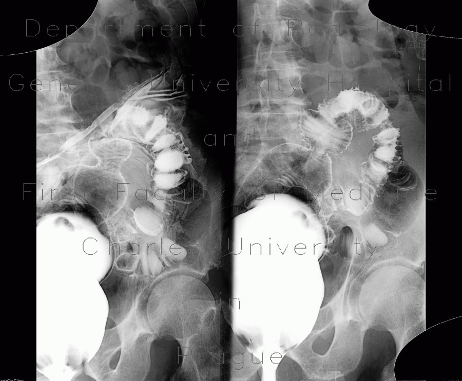 Diverticulitis, compressed diverticula