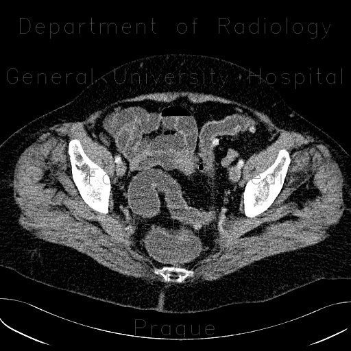 Diverticulum of large bowel with thickened wall