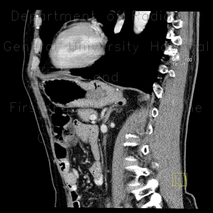 Diverticulum of stomach