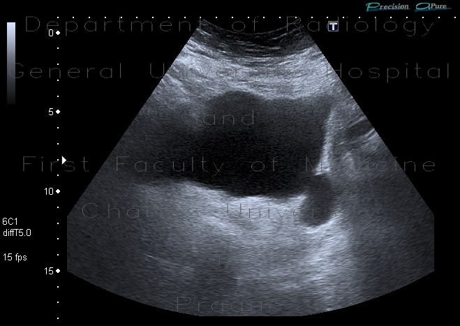 Diverticulum of urinary bladder