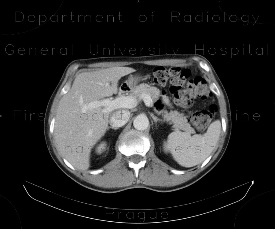 Dorsocaudal branch of the portal vein