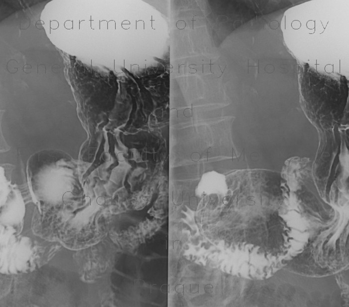 Duodenal bulb ulcer