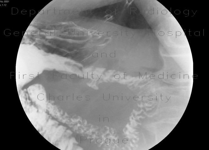Duodenal diverticulum