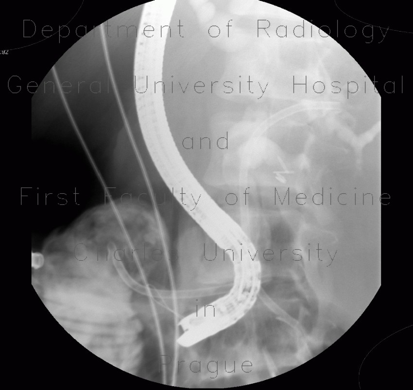 ERCP, migration of duodenobiliary drain