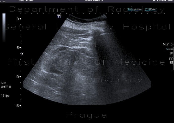 Edema of perinephric fat