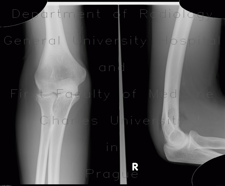 Elbow effusion, fat pad, sail sign