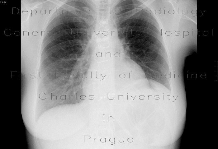 Elevation of left hemidiaphragm