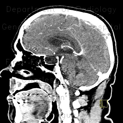 Empty sella, hypophysis