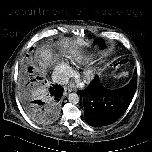 Empyema of thorax