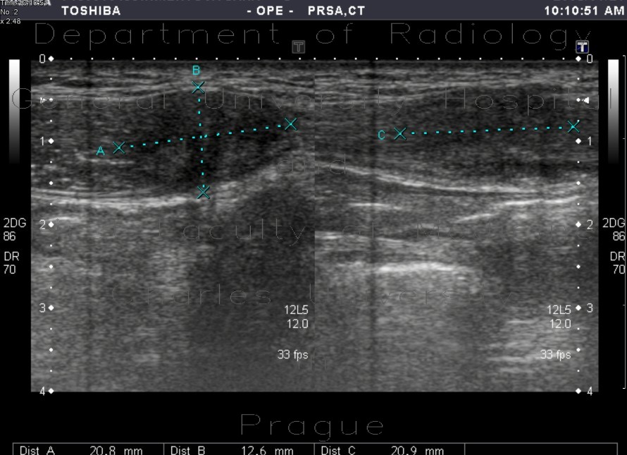 Endometriosis of the abdominal wall