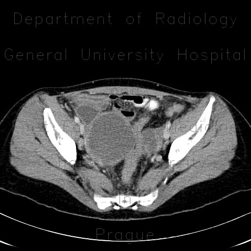 Endometriosis, ovarian endometriosis