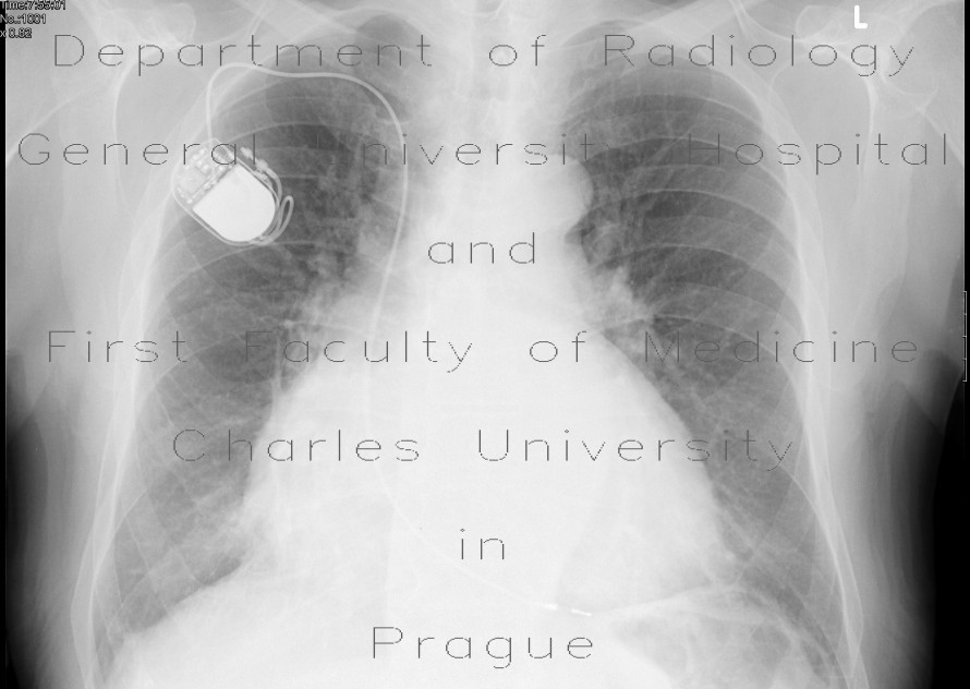 Enlarged heart