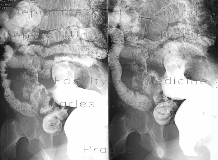 Entero-sigmoid fistula, enteroclysis
