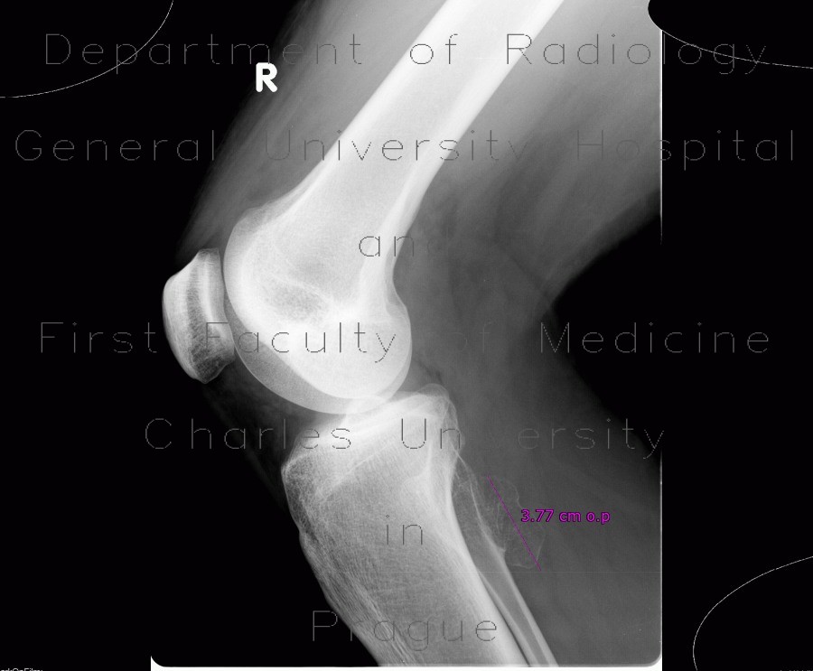 Exostosis of fibula