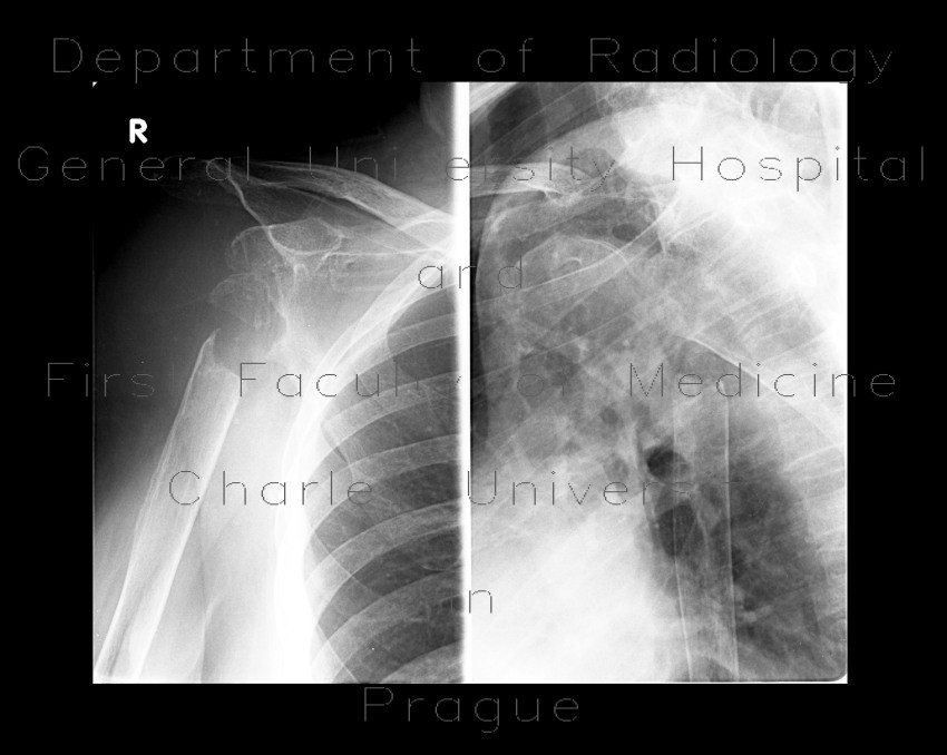 Extraction of head of humerus