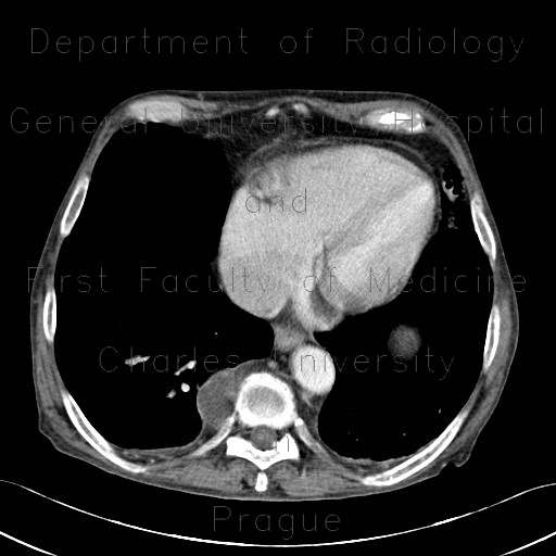 Extramedullary hematopoesis, paravertebral, splenomegally, spherocytosis, hereditary spherocytosis, intramuscular hematoma, iliacus muscle