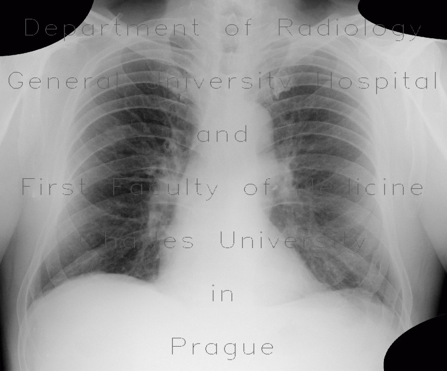 Fenestration of rib