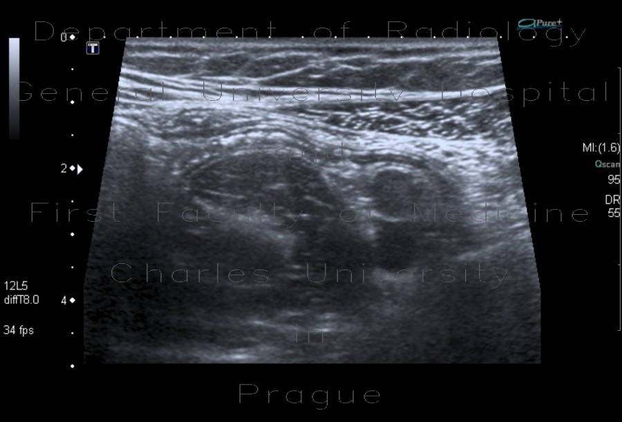 Fetal orifice of appendix