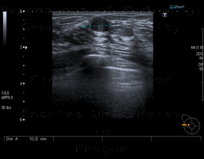 Fibroadenoma of breast