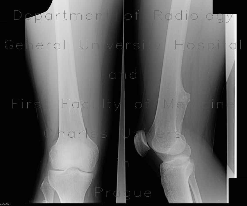 Fibrocartilaginous exostosis