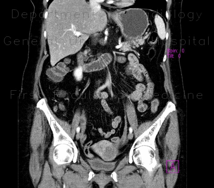 Fibroid of uterus