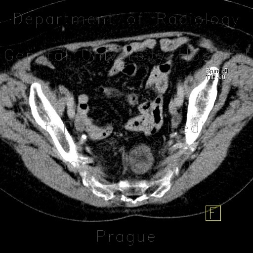 Fibrolipoma in pelvis