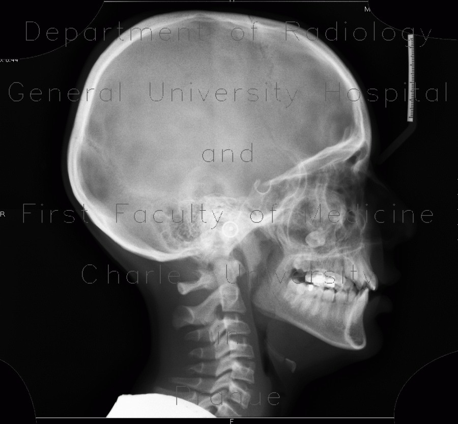 Fibrous dysplasia of the left maxillary sinus