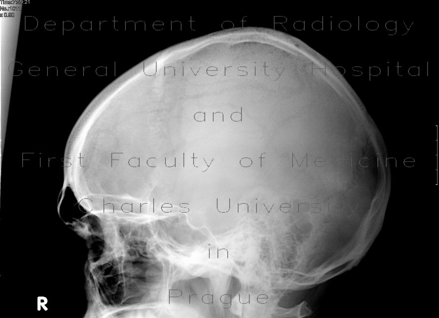 Fissure of the skull and epidural hematoma