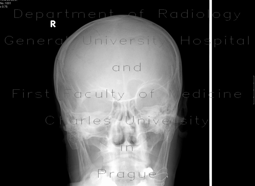 Fissure of the skull, mandible