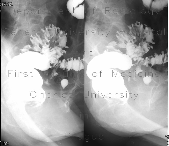 Fistula of sigmoid colon, diverticulosis, irrigography