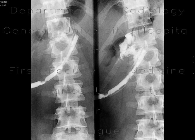 Fistulography of a cavity adjacent to pancreas
