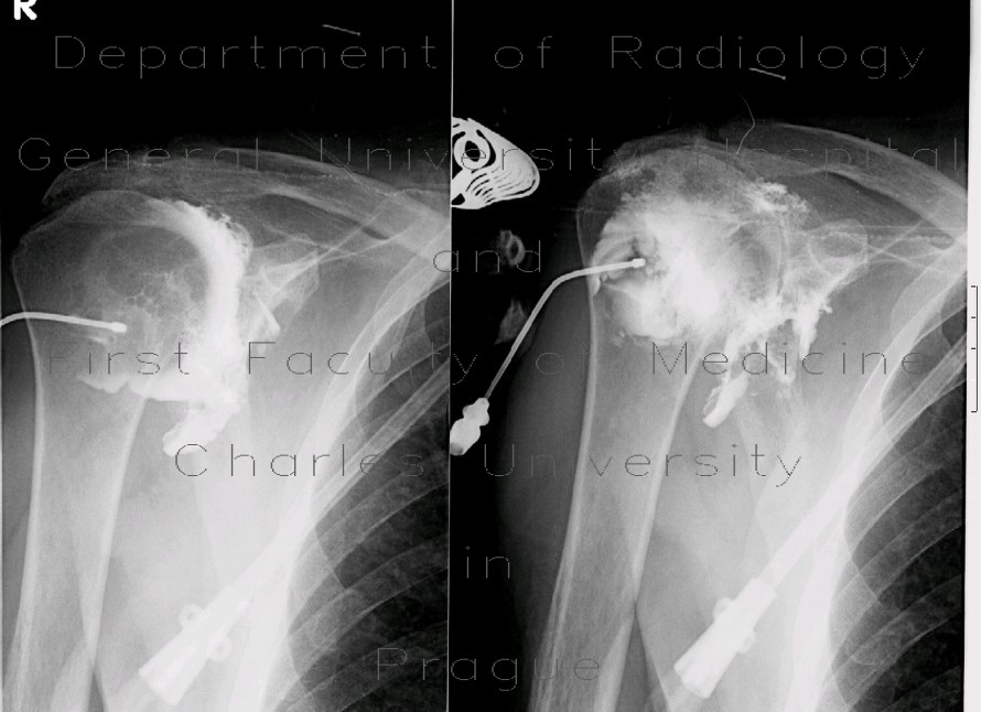 Fistulography of right shoulder