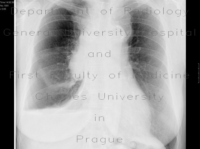 Fluidopneumothorax