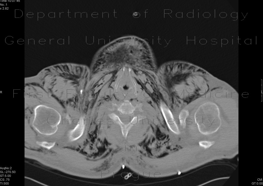 Fluidopneumothorax, pneumomediastinum, subcutaneous emphysema, muscular emphysema, pneumocolum