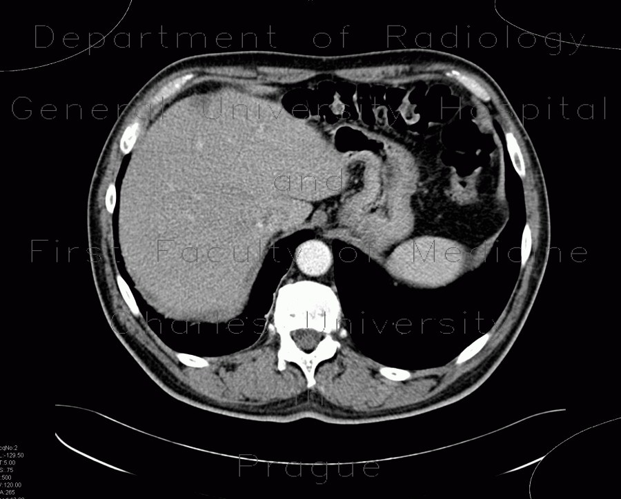 Focal hepatopathy, falciform ligament