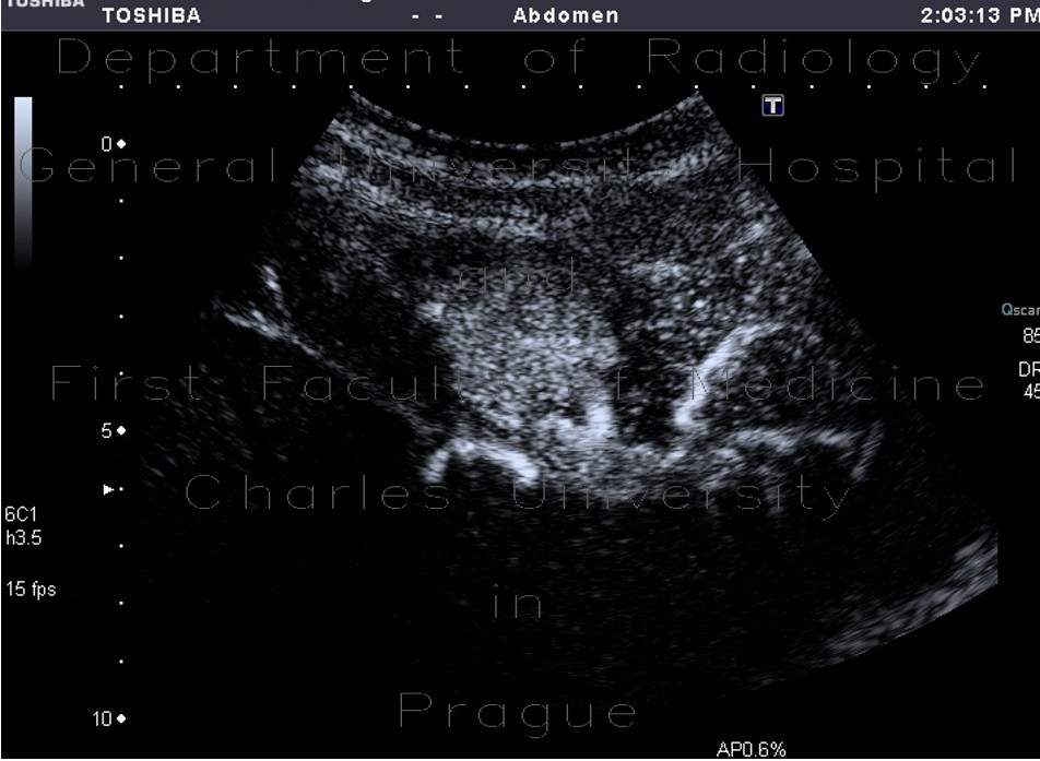 Focal nodular hyperplasia (FNH), CEUS