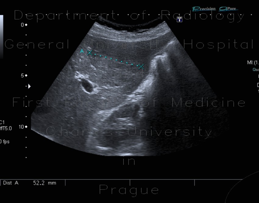 Focal nodular hyperplasia, FNH
