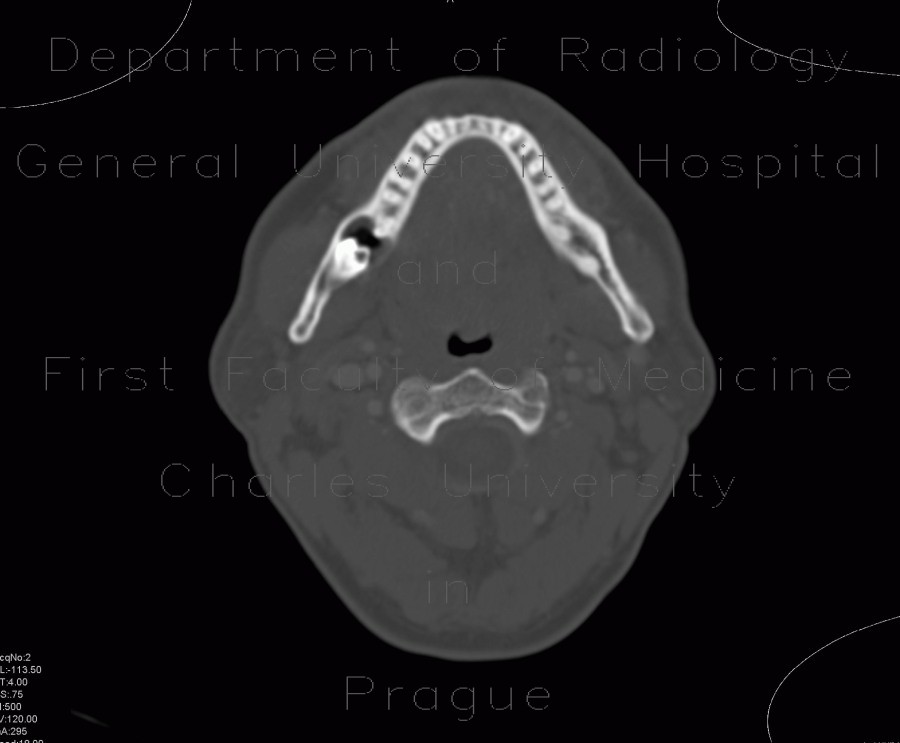 Follicular cyst