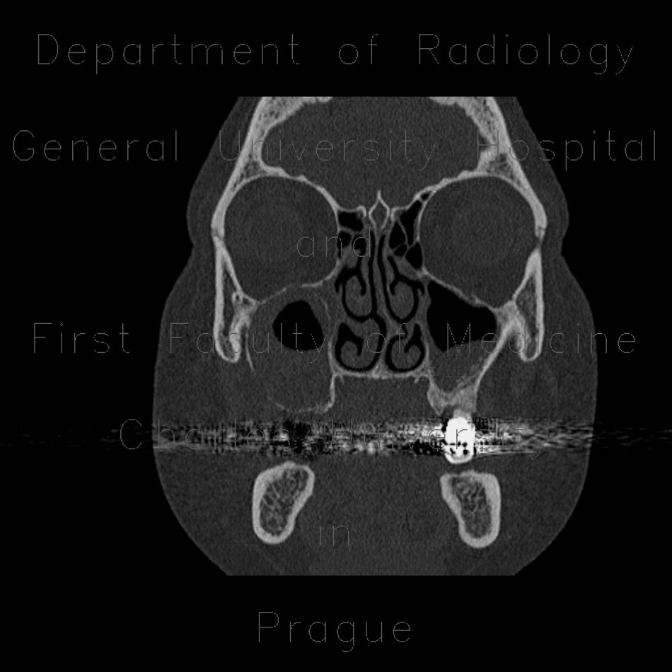 Follicular cyst of the maxillary sinus